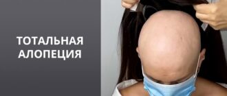 Тотальна алопеція6 симптоми, причини, лікування та фактори ризику