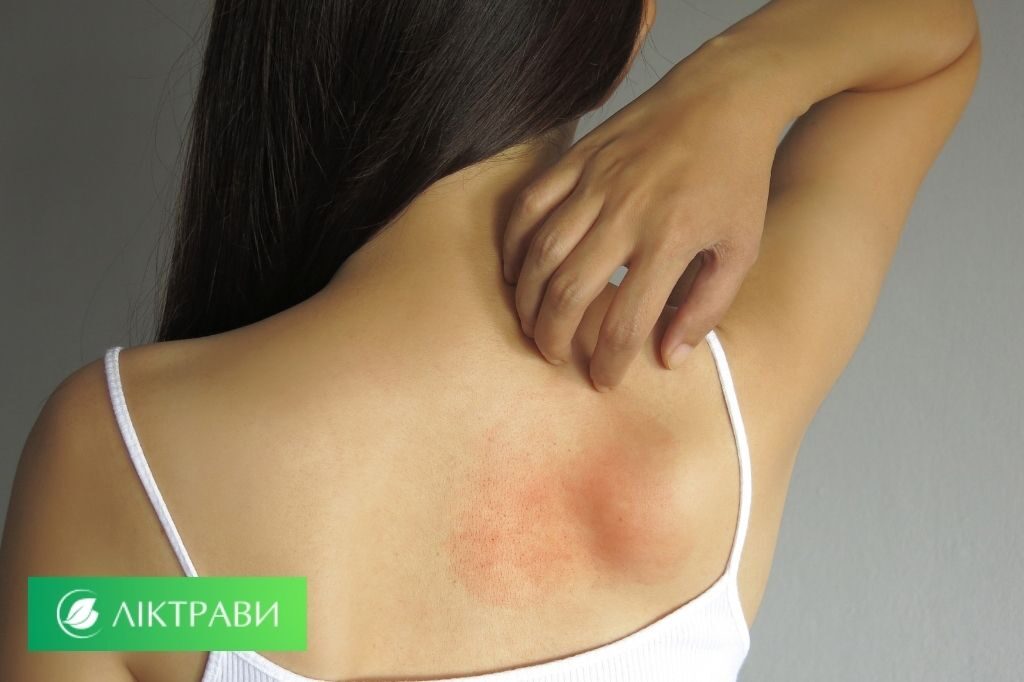 Запалення на шкірі