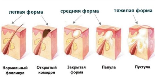 Прищі на шкірі голови