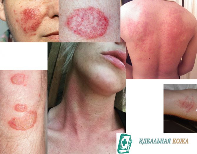 Червоні плями на шкірі