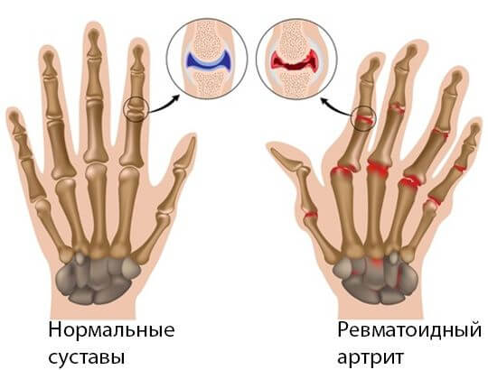 Артрит