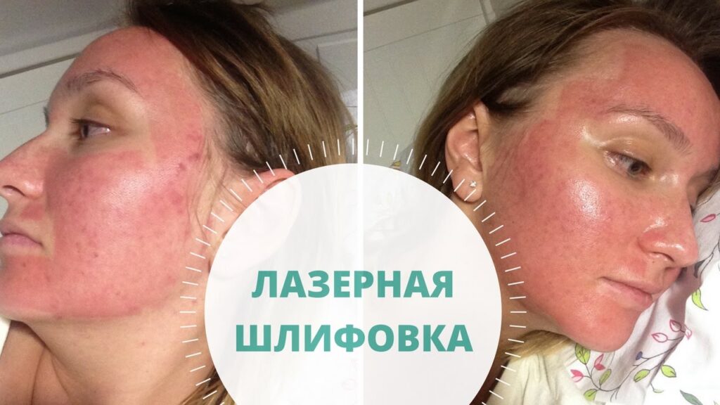 Лазерная шлифовка