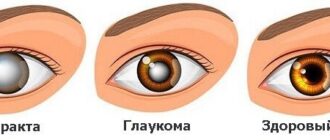 глаукома
