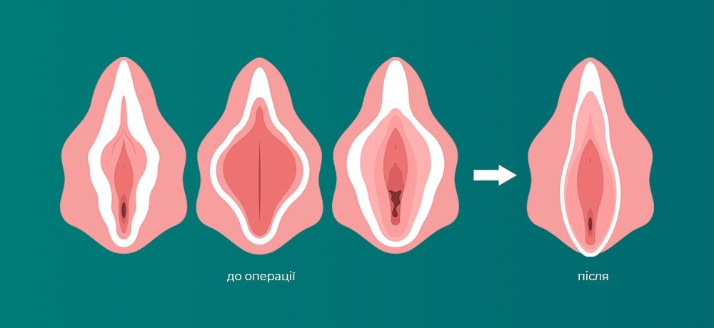 Що таке інтимна пластика